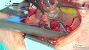 Aortic valve replacement, atrial fibrillation Box Ablation and left appendage clipping through mini-sternotomy