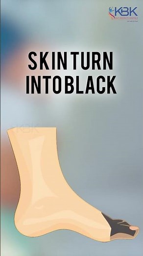 3 Gangrene Mistakes You Might Be Making