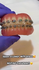 Upper & Lower With Brace!!!😍 | Denture Denture