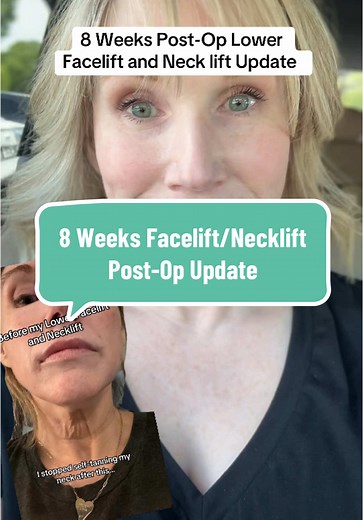 8 weeks post-facelift neck lift… what’s REALLY healing, what’s still tight, and why I finally feel like myself again. Let’s talk scars, swelling & surprises. #FaceliftRecovery #8WeeksPostOp #NeckLiftJourney #HealingUpdate #WomenOver50 #RealResults