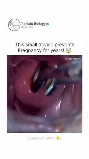 BIOLOGY | MEDICAL | LIFE on Instagram: "Ever wondered how Copper-T (Intrauterine Device) works? Copper-T is a small T-shaped device placed inside the uterus that helps prevent pregnancy for 5–10 years. The copper releases ions that make the uterus environment unfriendly for sperm, stopping fertilization naturally. It is a non-hormonal, long-term, and reversible birth control method recommended by doctors. Follow us @explainabio for more ✨ . . . . . . . . . . #CopperT #IUD #IntrauterineDevice #Bi