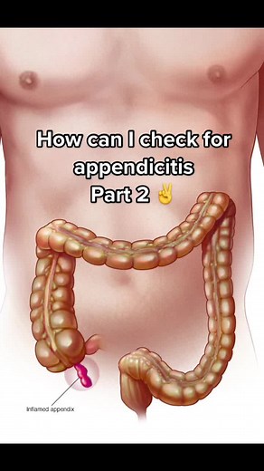 Appendicitis ☑️#appendix #viral#foryou #fyp #study #medicine #medico #human #body #part#2 #pain