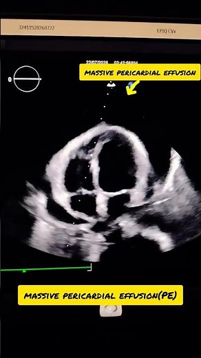 Massive Pericardial Effusion on Echocardiography | Life-Threatening Cardiac Emergency 💔