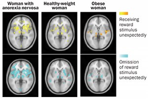 Causes of Anorexia Nervosa