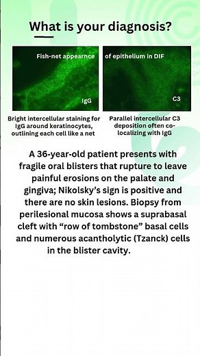 Fish-net appearance of intercellular IgG and C3 on DIF #oralpathology #pemphigus #ihc