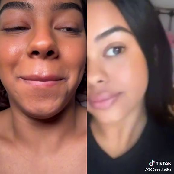 Chin dimpling correction using toxin #botox #botoxresults #botoxcheck #botoxfacial #fy #fyp