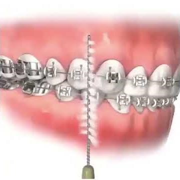 How to use interdental brushes with braces