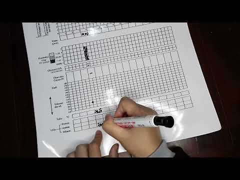 Mudah Pengisian atau Penulisan Partograf dalam Persalinan