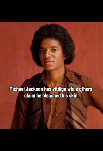 Did you believe the lies ? Michael Jackson had vitiligo #vitiligo #michaeljackson