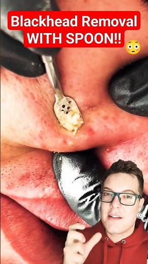 Crazy BLACKHEADS REMOVAL Fail #shorts
