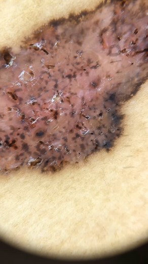 Dermoscopy - Skin cancer on Instagram: "Basal Cell Carcinoma (BCC). Courtesy of colleague @carlademarque.dermato Dermoscopy: Spoke-wheel-like structures + leaf-like areas + ulcerations + milky-red areas. Pictures: @dermlite DL5 Support: @bleymed #dermoscopy #dermatoscopy#dermatoscopia #melanoma #skincancer #dermatologia #dermatology #trichoscopy #tricoscopia"