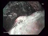 Adenocarcinoma of Cardia with Signet Ring Cells (3 of 6) • Video • MEDtube.net