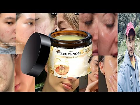 Bee Venom Treatment Cream | Honest Review