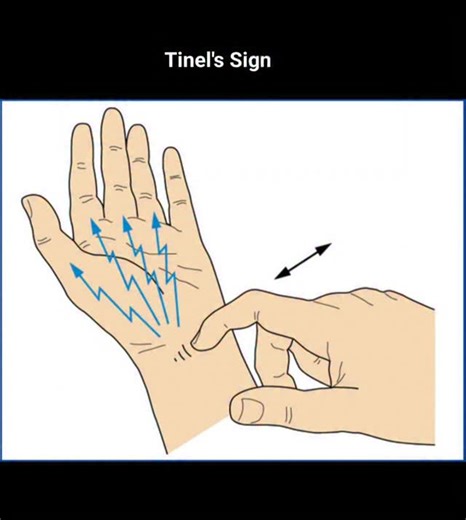 RK NURSE'S HUB on Instagram: "Tinel's sign is a clinical diagnostic test used to detect irritated, compressed, or regenerating nerves by lightly tapping (percussing) over a nerve to elicit a tingling, "pins and needles" sensation (paresthesia) in the distribution of that nerve . It is commonly used to diagnose carpal tunnel syndrome, cubital tunnel syndrome, and tarsal tunnel syndrome. Key Details About Tinel's Sign Procedure: A healthcare provider taps along a nerve path, typically moving from