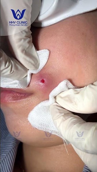 Squeezing out abscesses in the mouth area.