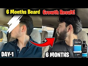 My 6 Month Beard Growth Journey | Real Results + Tips | Minoxidil Beard growth | Mintop minoxidil 5