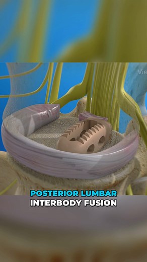 85K views · 597 reactions | Got a spinal disc that’s gone full...