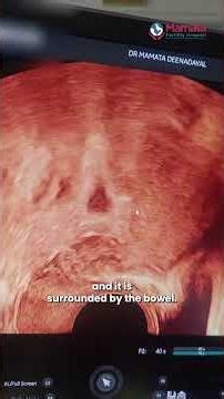 How Doctors Detect Pelvic Adhesions on Scan! | Mamta Fertility Hospital | Hyderabad