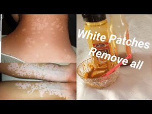 How to Get Rid Of WHITE SPOTS On Skin | Skin Bleaching Spots