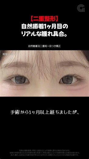 自然癒着の二重まぶたの腫れは1ヶ月でどれくらい引くのか？