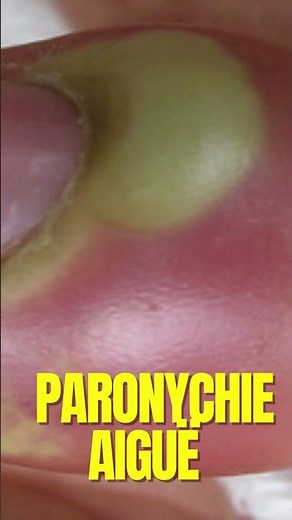 Paronychia: definition, symptoms and treatments