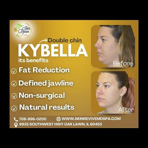 Kybella Treatment (Double Chin)