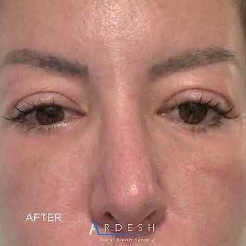 Lower Blepharoplasty Results | Before and After | Los Angeles | Dr. Ardesh