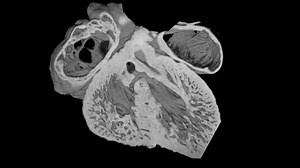 Iron deficiency anaemia in early pregnancy increases risk of heart defects, suggests new research