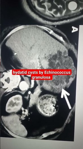 Echinococcus granulosus Hydatid Cysts in Brain and Liver #medical #microbiology #usmle