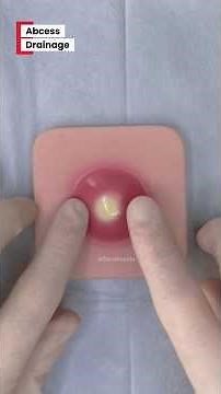 Abcess drainage in 5 steps #medstudent #medlife