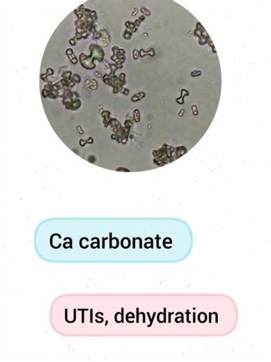 Understanding Urine Crystals in Medical Studies