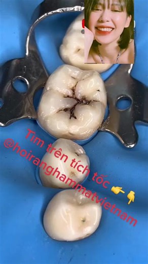 Tooth Extraction Techniques in Dental Clinics