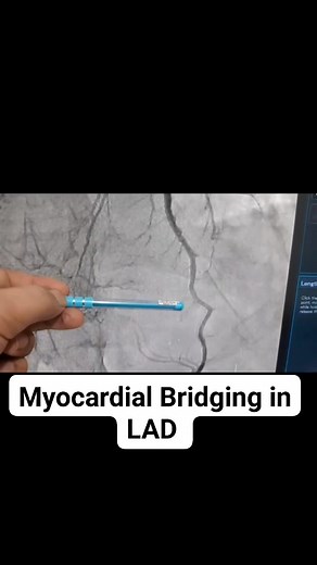 241K views · 1.2K reactions | Myocardial Bridge LAD | Cardiovascular Education | Facebook
