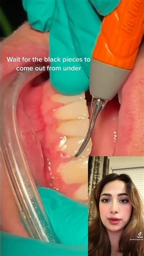 insightoracle on Instagram: "This video shows the process of deep cleaning which is also known as scaling and root planning …. AKA #srp which is performed by a #dentalhygienists or a #dentist let me know if you have ever had this type of #teethcleaning experience before and if you were numbed or not. I would love to hear from you guys about your experiences. #viral #instagood #dental #dentalhygiene #teeth #mouth creator credit: @Noeliasantanardh"