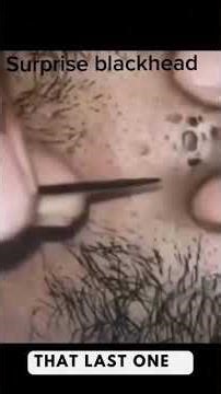 Removing large blackheads and pimples from face new 2026 #143