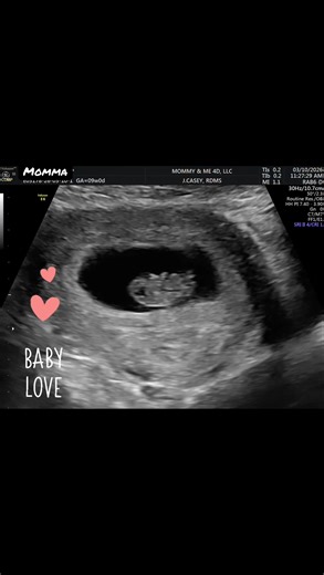 At 9 weeks pregnant, your baby is about the size of a grape 🍇 but already doing amazing things! ✨ The heart is beating strong — around 120–180 beats per minute✨ Tiny arms and legs are growing, and little elbows are forming✨ Fingers and toes are beginning to develop (no webbing soon!)✨ The baby may start making small movements, even though mom can’t feel them yet✨ Eyes, ears, nose, and lips are becoming more defined✨ The brain is developing rapidly, sending signals to the body✨ Your baby may eve