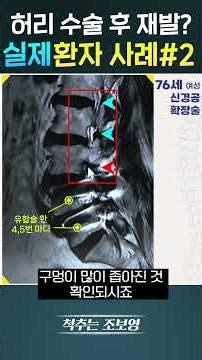 What if you experience discomfort again after back surgery? Real patient case, Part 2