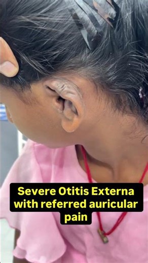 Severe otitis externa