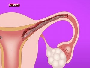 How Essure Works