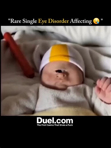 Rare Single Eye Disorder Affecting One in a Million 👁️🧬 This rare medical condition is known as Cyclopia, a severe congenital disorder 🧠 It occurs when the embryonic forebrain fails to divide into two distinct hemispheres 💡 As a result, only one central eye forms in the middle of the forehead 😢 Cyclopia often comes with other abnormalities like a missing nose or malformed mouth 👶 It’s caused by genetic mutations or exposure to toxic substances during pregnancy ⚠️ This condition develops ve
