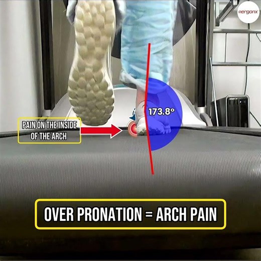 Overpronation causes arch pain