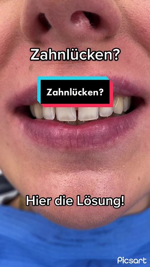 Effective Solutions for Zahnlücke: Flowable Injection Technique Explained