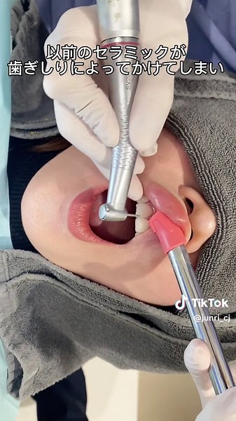 セラミックのやり方とは？セラミック治療の変更方法について