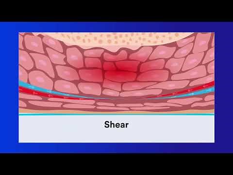 Pressure Injury Education: Chapter 2 Cause