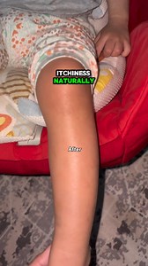 I'm always sad because of my daughter's eczema, dry and itchy skin. She's always scratching and uncomfortable. As a mom it really worries me. Until one day, I found Jolicare cream. Now she's no longer scratching all the time and it makes me really happy 💘 ----------- Jolicare – #1 Selling Repair Cream for Dry, Itchy, and Sensitive Skin in MY and SG, with 100,000 creams sold. ✨ 4-in-1 Skin Repair: Jolicare provides Instant Cooling, Itch Relief, Deep Moisturization, and Lasting Repair — transform