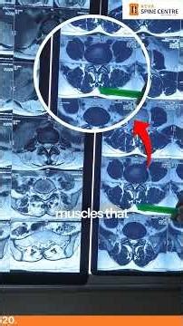 👉 Many patients worry when they have persistent back pain, but their MRI report shows “Normal.”