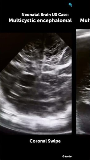 Neonatal Brain Ultrasound Case: Multicystic encephalomalacia
