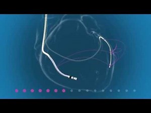 Attain Performa Quadripolar LV Lead and Viva Quad CRT-D System