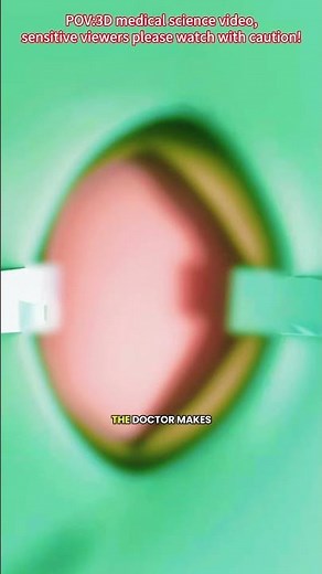 Inguinal Hernia Repair Surgery(3D Animation)
