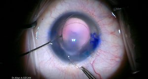 Aniridia With Astigmatism - Eyetube